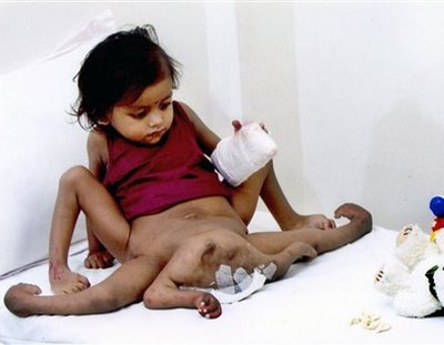 Fetus in FetusSe sabe que hay cerca de 100 casos documentados de ni&ntilde;os que padecen de ese mal. Se trata de dos gemelos que alcanzan a separarse y quedan unidos por alguna zona del cuerpo, generalmente la zona abdominal. Lo m&aacute;s raro de todo es que mientras uno de ellos logra crecer sano, el otro queda al interior del gemelo sano aliment&aacute;ndose de &eacute;ste, cu&aacute;l par&aacute;sito.Se sabe que hay cerca de 100 casos documentados de ni&ntilde;os que padecen de ese mal. Se trata de dos gemelos que alcanzan a separarse y quedan unidos por alguna zona del cuerpo, generalmente la zona abdominal. Lo m&aacute;s raro de todo es que mientras uno de ellos logra crecer sano, el otro queda al interior del gemelo sano aliment&aacute;ndose de &eacute;ste, cu&aacute;l par&aacute;sito.